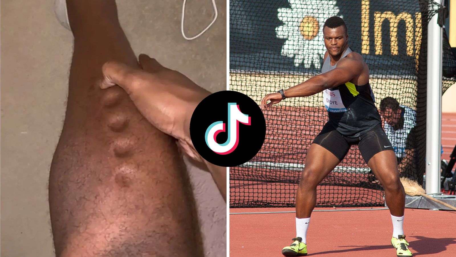Olympian goes viral showing his “Play-Doh” legs caused by deadly infection