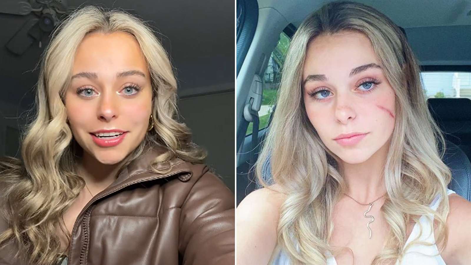 TikTok's 'Scar Girl' Opens Up About Viral Fame
