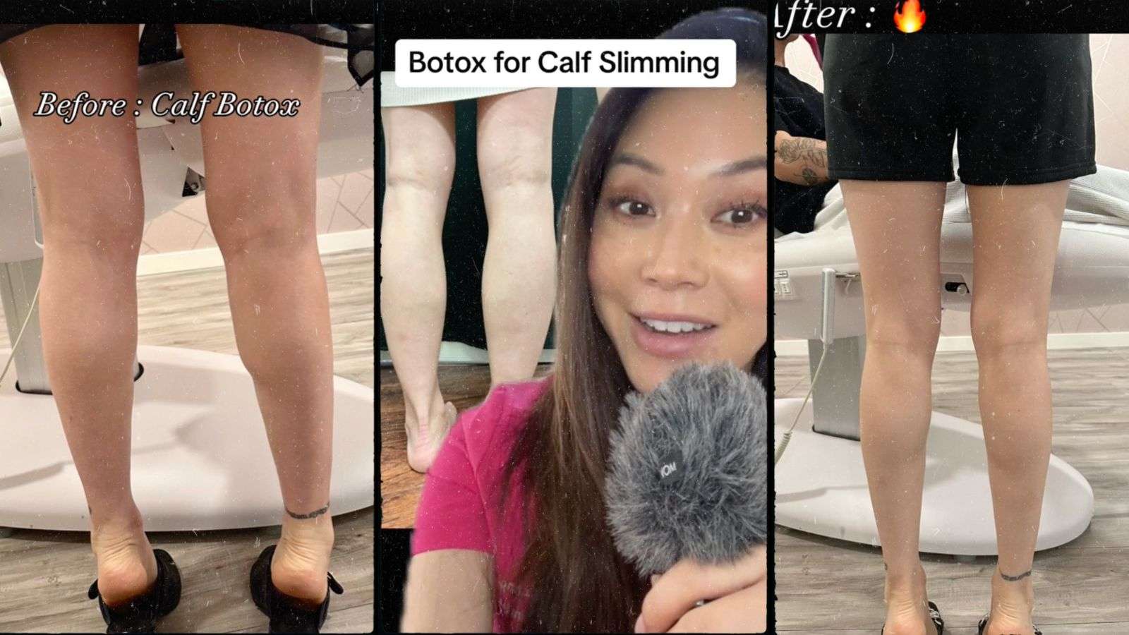 Ozempic for legs? 'Calf tox' is newest slimming fad on TikTok