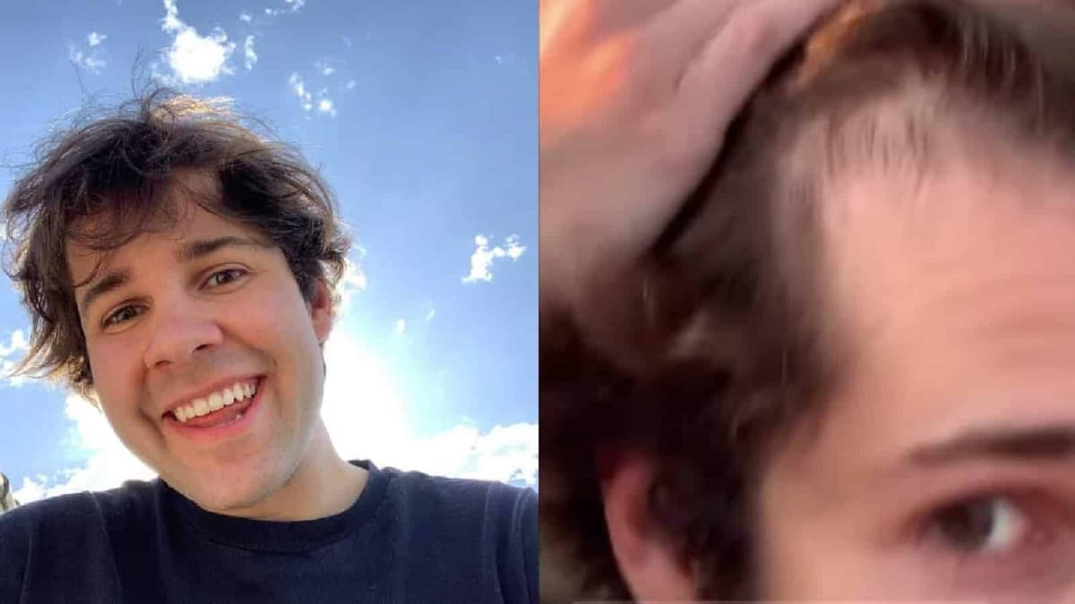 David Dobrik going bald