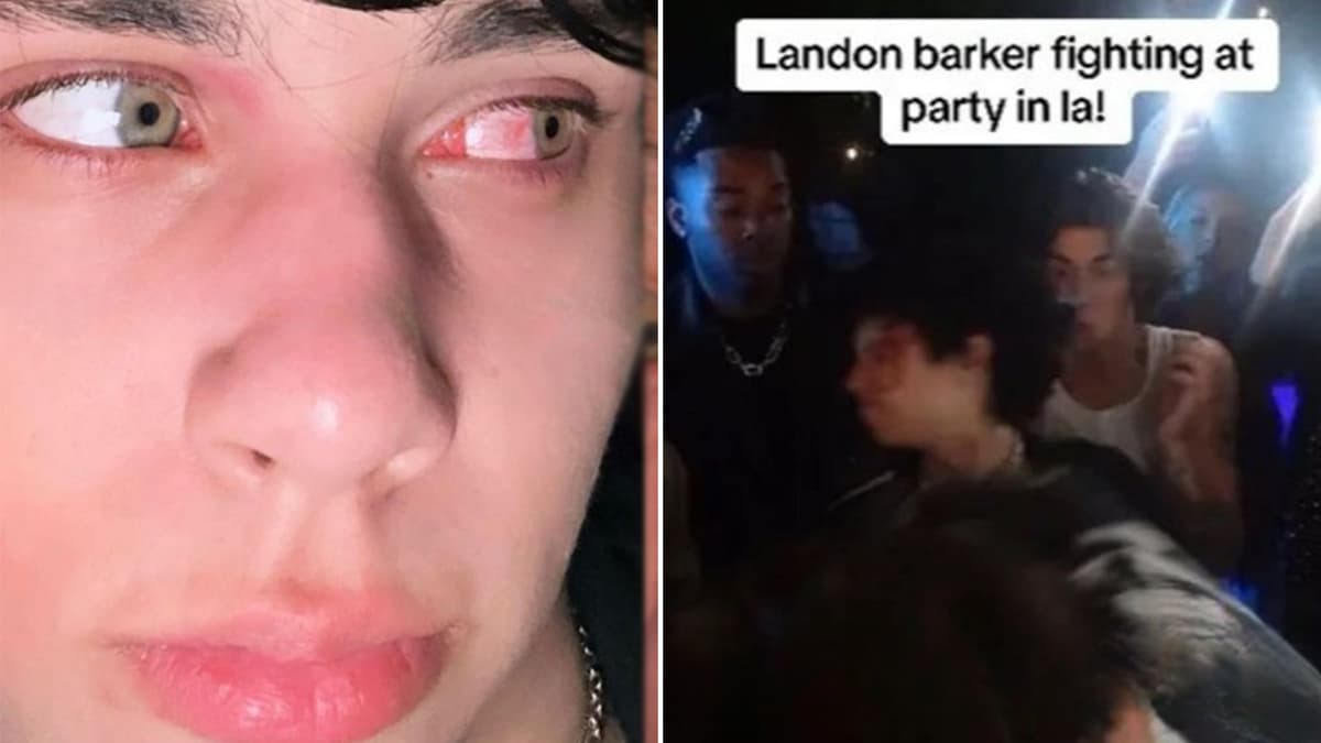 landon-barker-bloody-eye-fight-charli-damelio