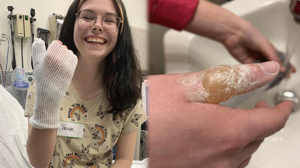 Allison Boles at the hospital after receiving 2nd-degree burns, as seen on the right hand side.