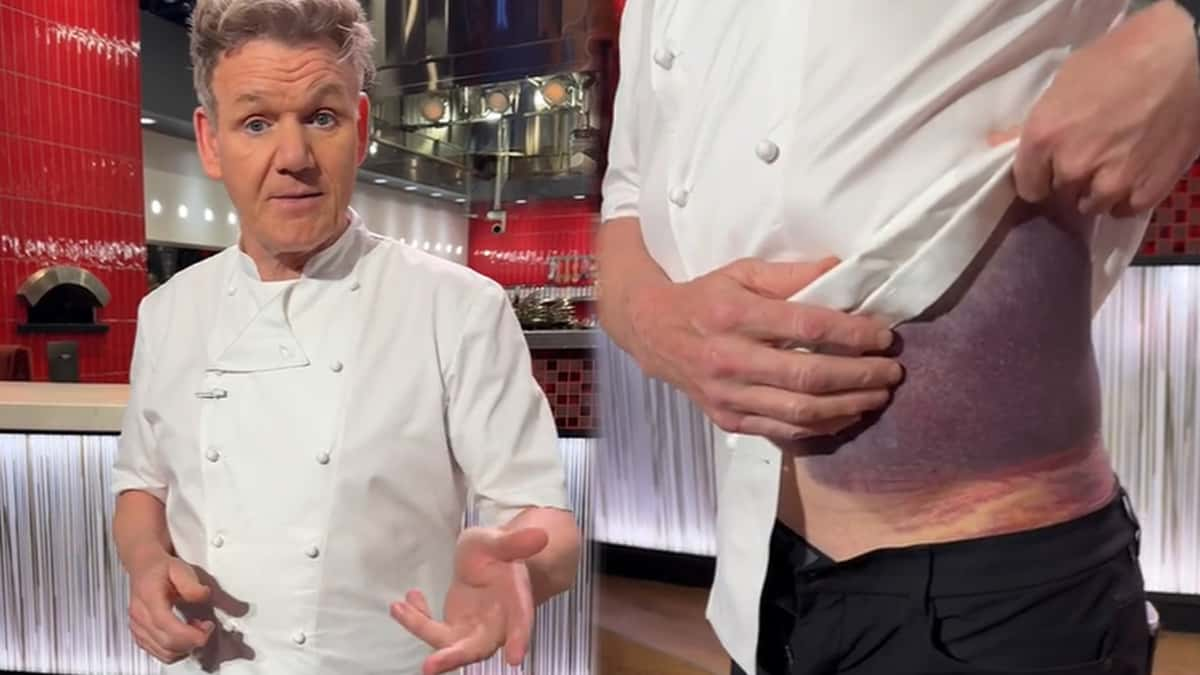 Gordan Ramsey showing off his bruising